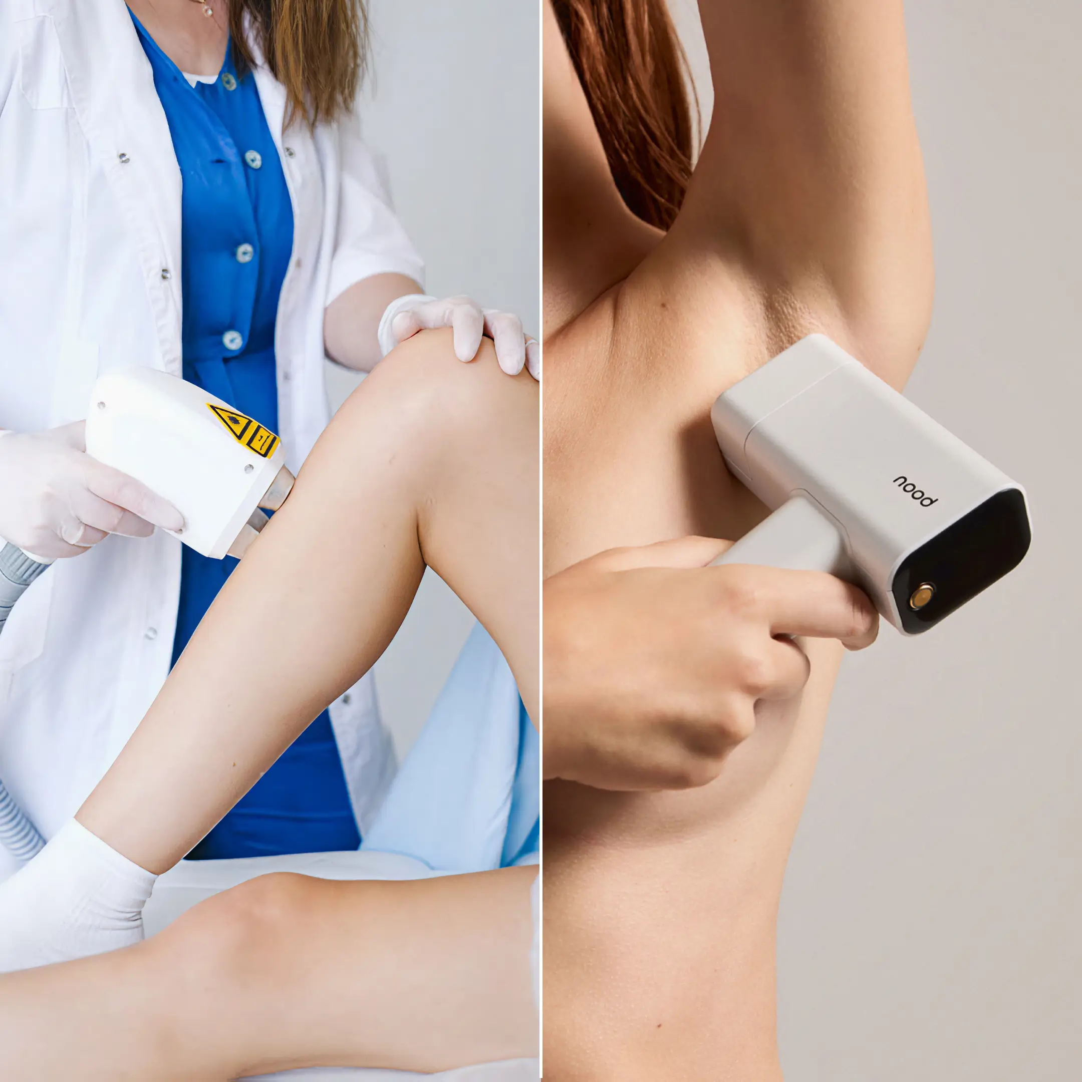Nood vs. Hair Removal Clinic: How This At-Home IPL Saves Money and Time